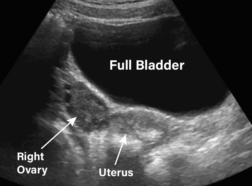 gynae ultrasound